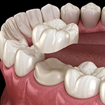 a 3D depiction of a dental crown