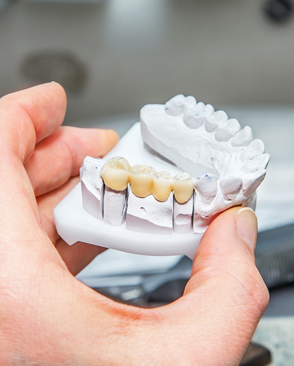 Dentist holding a model of the mouth with a dental bridge over four teeth