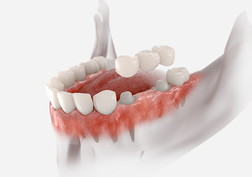 Illustration of a dental bridge being fitted over two natural teeth to close the gap between them