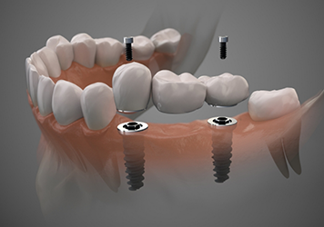Illustration of a dental bridge being supported by two dental implants