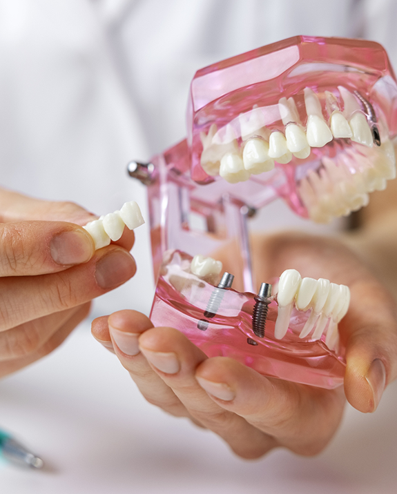 Dentist holding a model of the mouth and a dental bridge