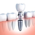 Diagram highlighting the components of a dental implant in Ellington