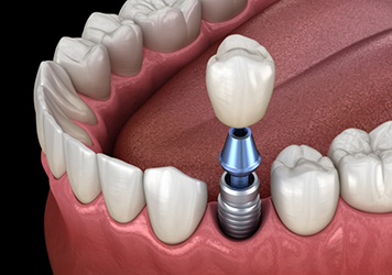 Illustration of a dental implant with a dental crown replacing one missing tooth