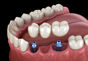 Illustration of a dental bridge being placed onto two dental implants