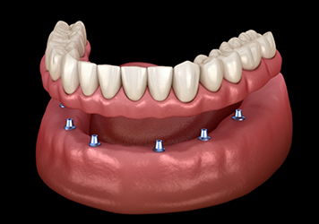 Illustration of a full denture being placed onto six dental implants
