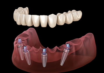 Illustration of a full denture being supported by four dental implants throughout the arch