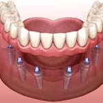 Digital illustration of dental implant dentures in Ellington
