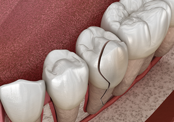 Illustration of a cracked tooth