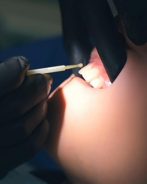 Close up of a dental patient having fluoride applied to their teeth