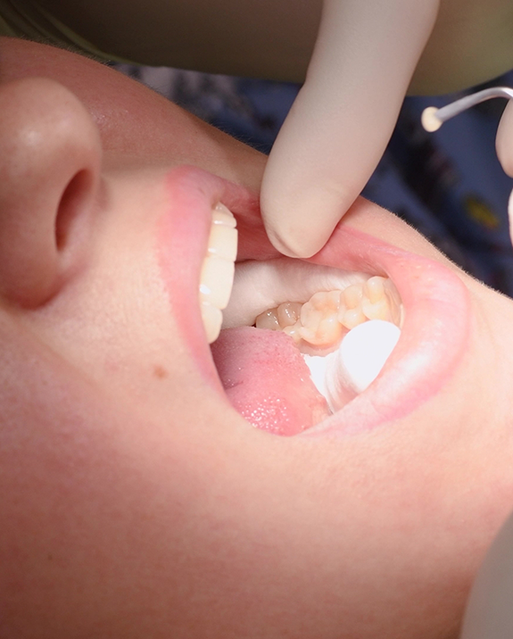 Close up of a dentist placing a white filling in a tooth