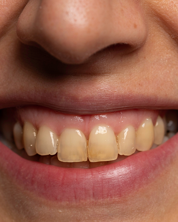 Close up of a person with yellowed teeth smiling before teeth whitening in Ellington