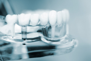 Dental implants in plastic model of mouth with model teeth
