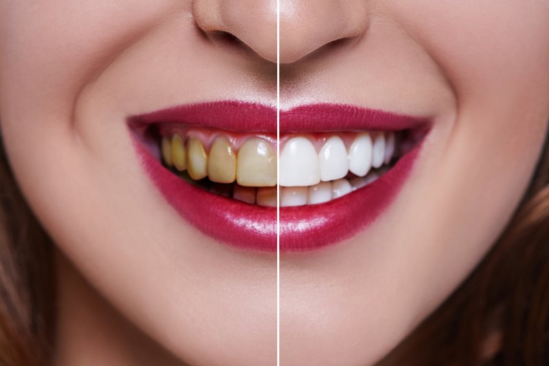 Teeth Whitening in Ellington Professional Whitening Zahner Dental